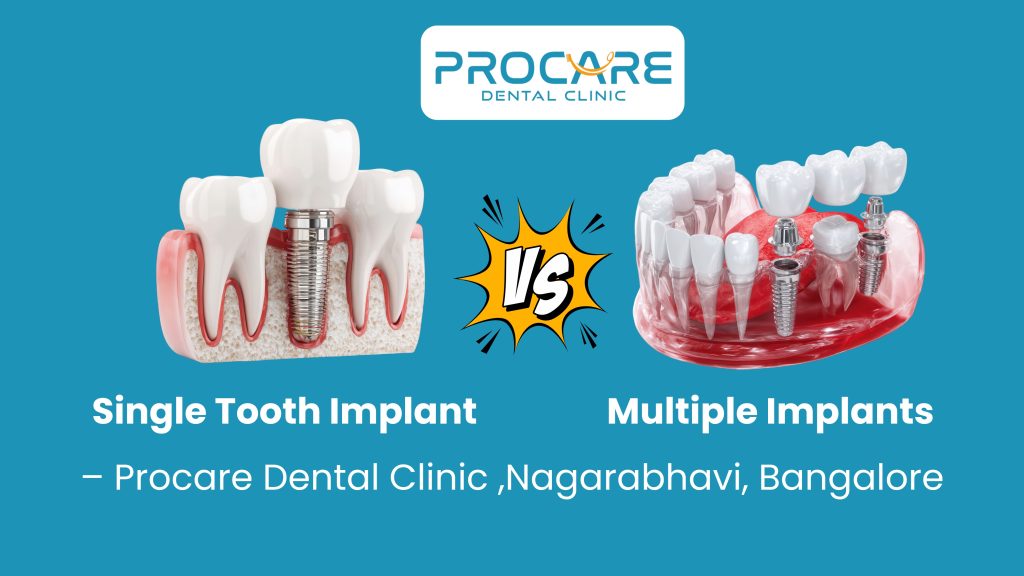 Single Tooth Implant vs Multiple Implants – Procare Dental Clinic, Nagarabhavi, Bangalore