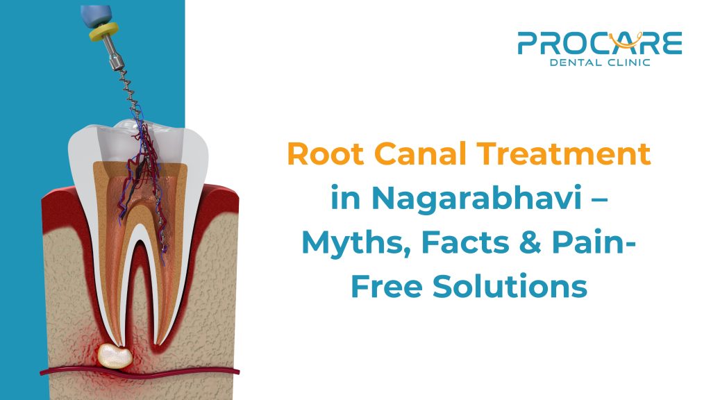 Root Canal Treatment in Nagarabhavi – Myths, Facts & Pain-Free Solutions