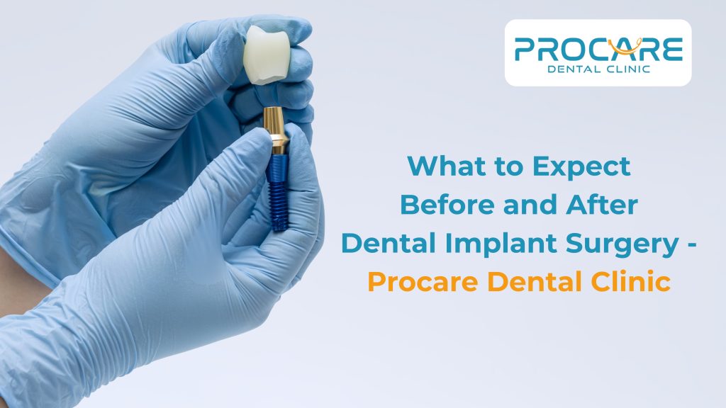 What to Expect Before and After Dental Implant Surgery – Procare Dental Clinic