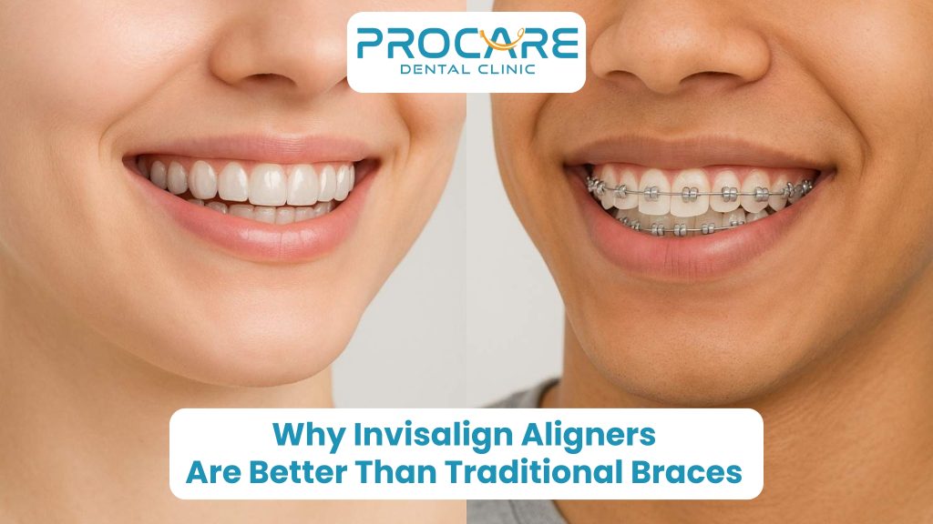 Why Invisalign Aligners Are Better Than Traditional Braces