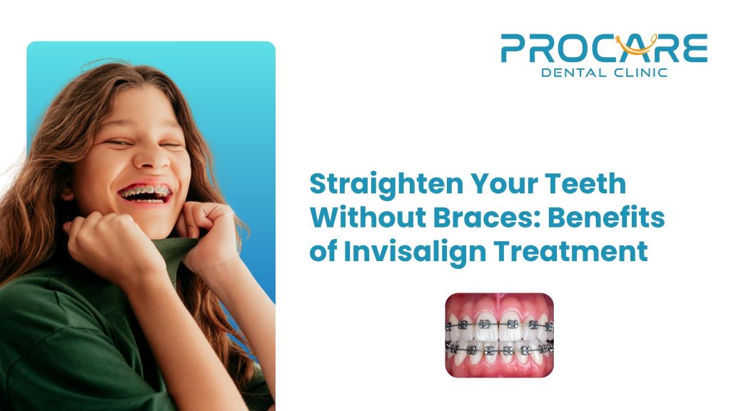 Straighten Your Teeth Without Braces: Benefits of Invisalign Treatment